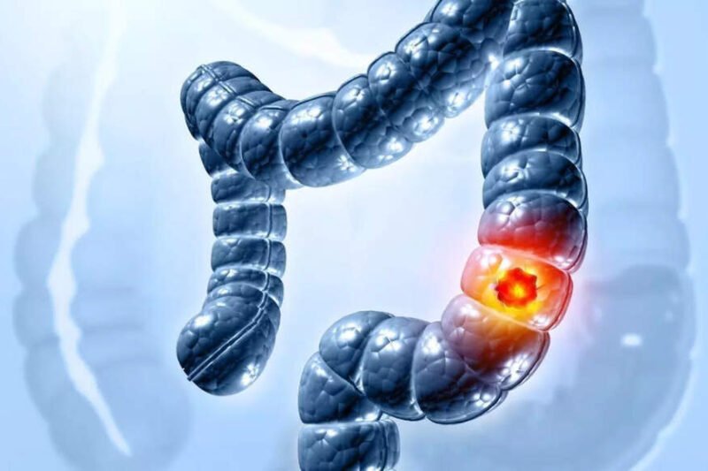 Colon Cancer Symptoms: Colon cancer rising among youngsters: Top US doc alerts about 5 warning signs |
