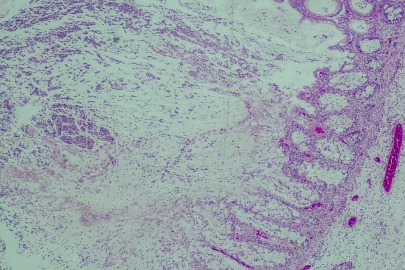 UK health warning after cases of deadly bacteria C. diff soar to 12 year high | News UK