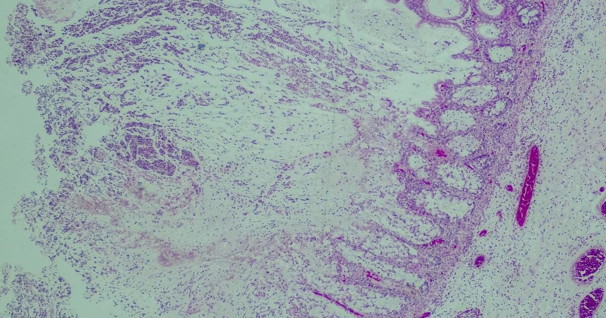 UK health warning after cases of deadly bacteria C. diff soar to 12 year high | News UK